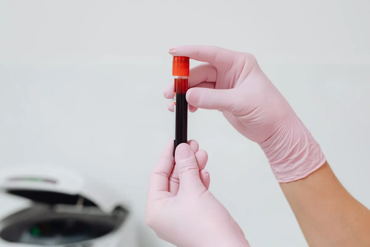 Gloved hands holding a blood sample tube for a dengue NS1 test and platelet count
